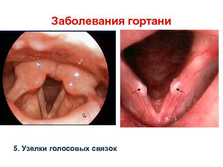 Заболевания гортани 5. Узелки голосовых связок 