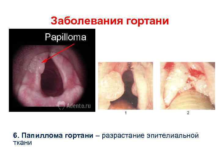 Заболевания гортани 6. Папиллома гортани – разрастание эпителиальной ткани 