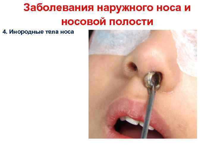 Заболевания наружного носа и носовой полости 4. Инородные тела носа 