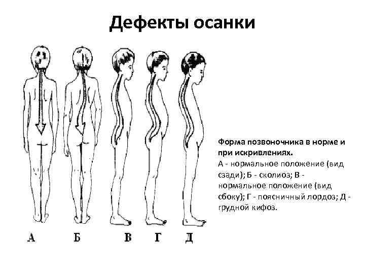 Дефекты осанки Форма позвоночника в норме и при искривлениях. А - нормальное положение (вид