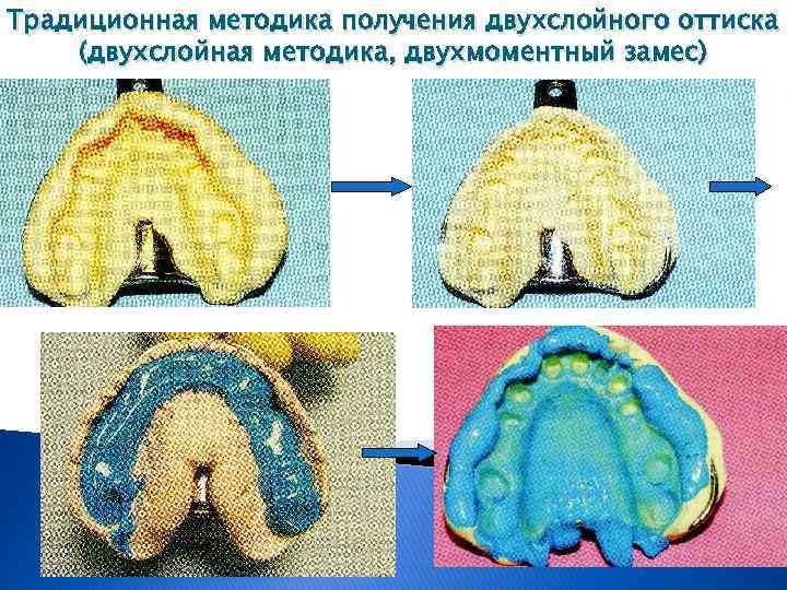 Традиционная методика получения двухслойного оттиска (двухслойная методика, двухмоментный замес) 