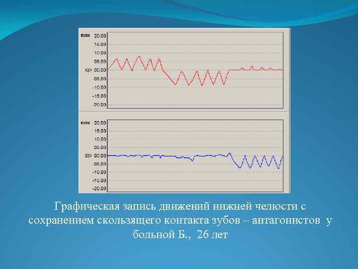 Графическая запись движений нижней челюсти с сохранением скользящего контакта зубов – антагонистов у больной