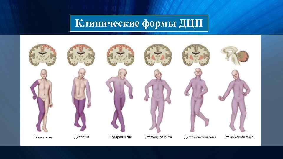 Клинические формы ДЦП 