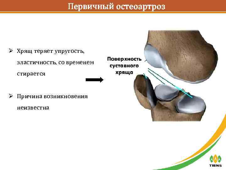 Первичный остеоартроз Ø Хрящ теряет упругость, эластичность, со временем стирается Ø Причина возникновения неизвестна