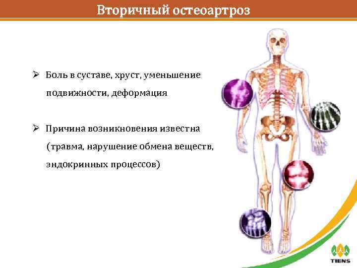 Вторичный остеоартроз Ø Боль в суставе, хруст, уменьшение подвижности, деформация Ø Причина возникновения известна