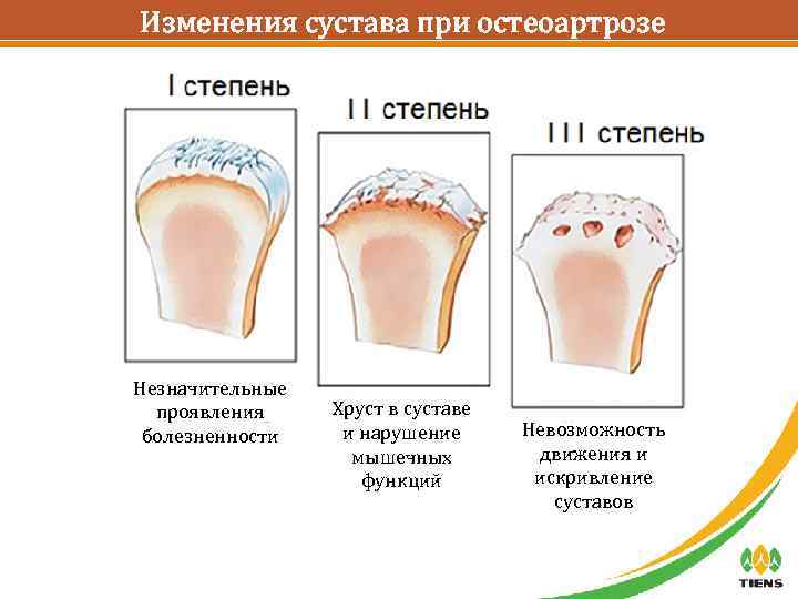 Изменения сустава при остеоартрозе Незначительные проявления болезненности Хруст в суставе и нарушение мышечных функций