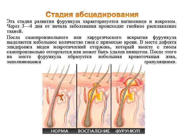 Эта стадия развития фурункула характеризуется нагноением и некрозом. Через 3— 4 дня от начала