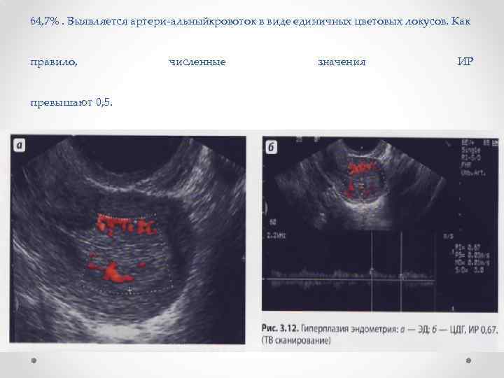 64, 7%. Выявляется артери альныйкровоток в виде единичных цветовых локусов. Как правило, превышают 0,