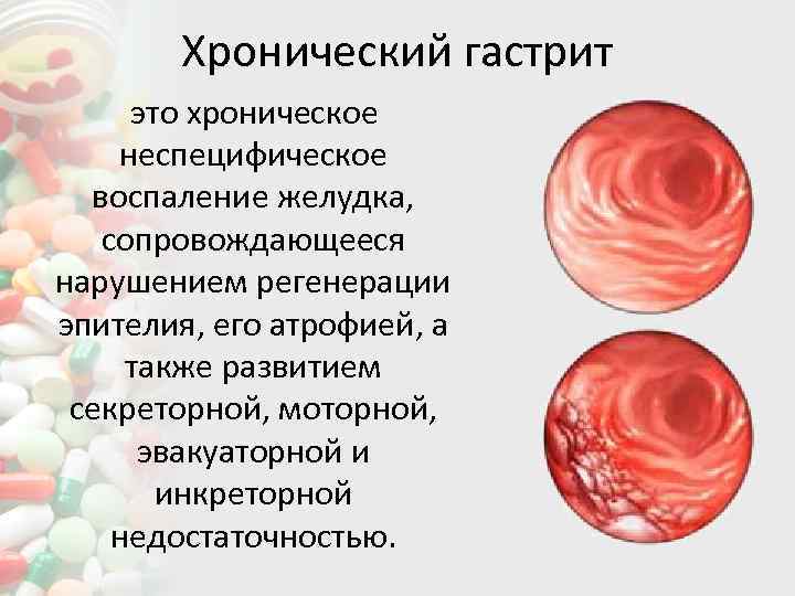 Хронический гастрит это хроническое неспецифическое воспаление желудка, сопровождающееся нарушением регенерации эпителия, его атрофией, а