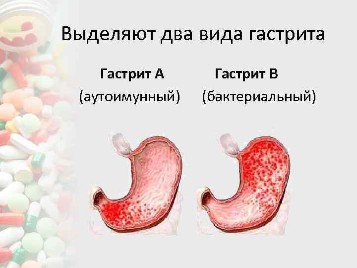 Особенности сестринского процесса при гастритах схема