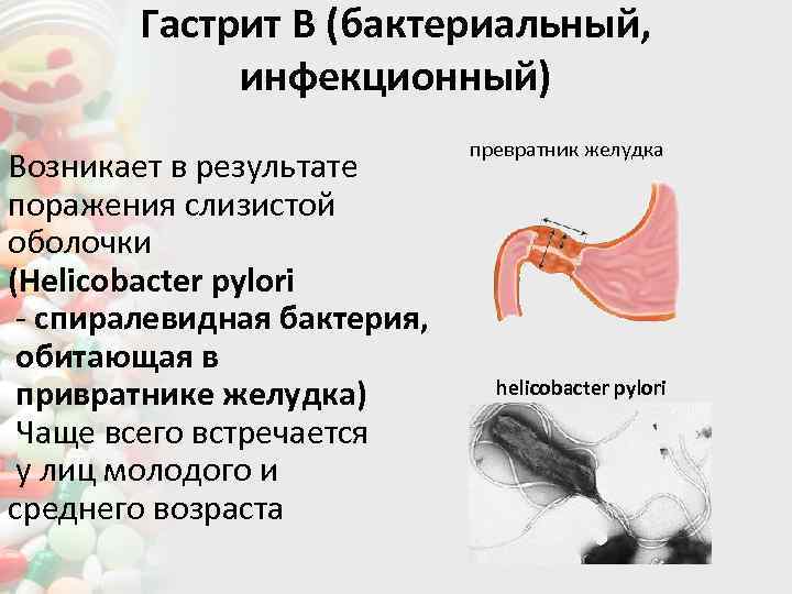 Гастрит В (бактериальный, инфекционный) Возникает в результате поражения слизистой оболочки (Helicobacter pylori - спиралевидная