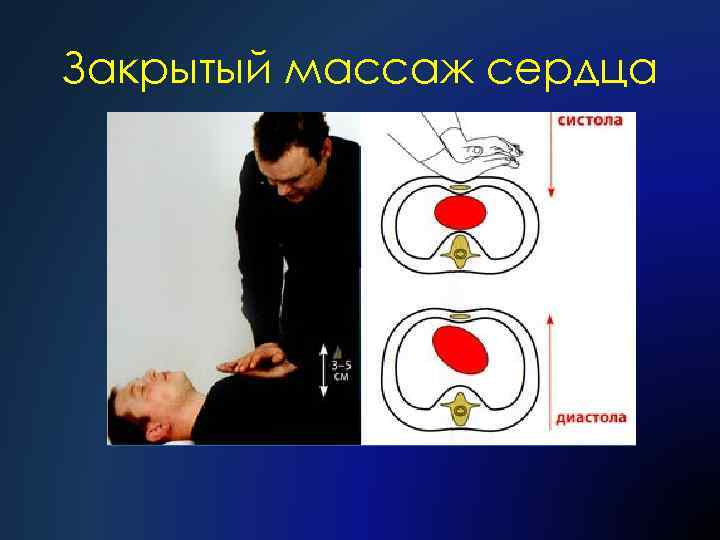 Закрытый массаж сердца 