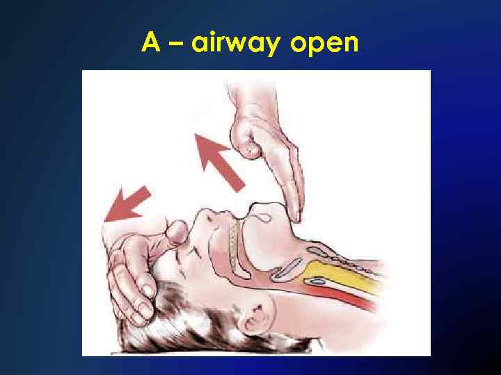 А – airway open 