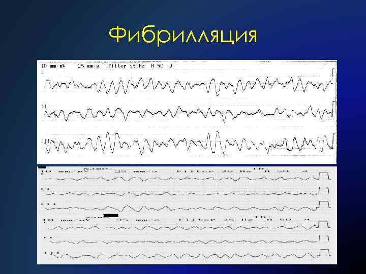 Фибрилляция 