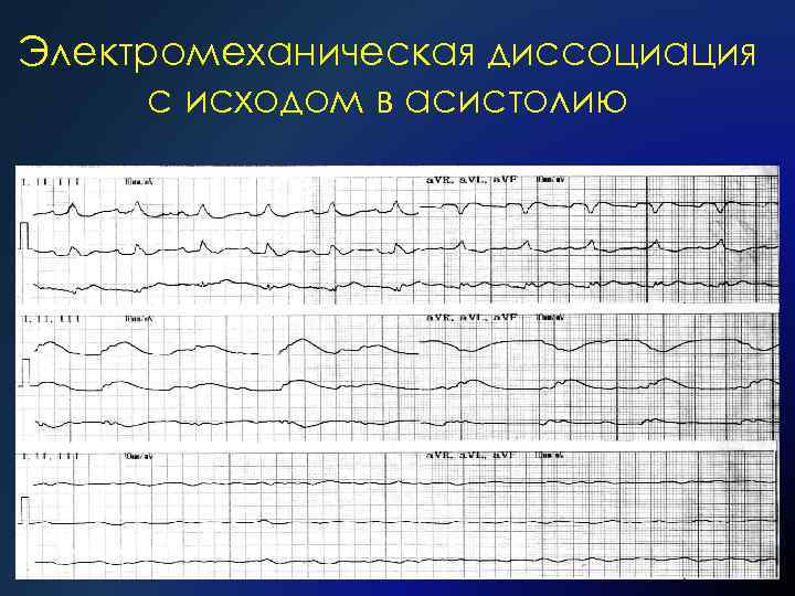 Электромеханическая диссоциация с исходом в асистолию 