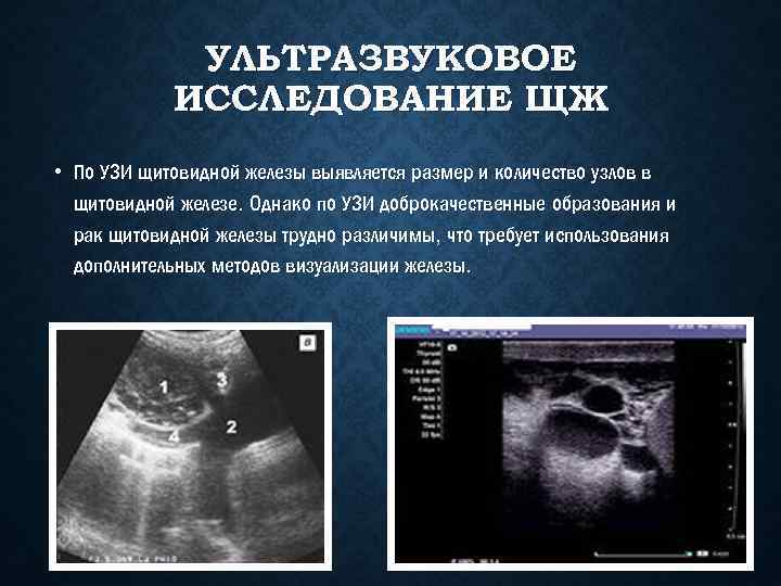 УЛЬТРАЗВУКОВОЕ ИССЛЕДОВАНИЕ ЩЖ • По УЗИ щитовидной железы выявляется размер и количество узлов в