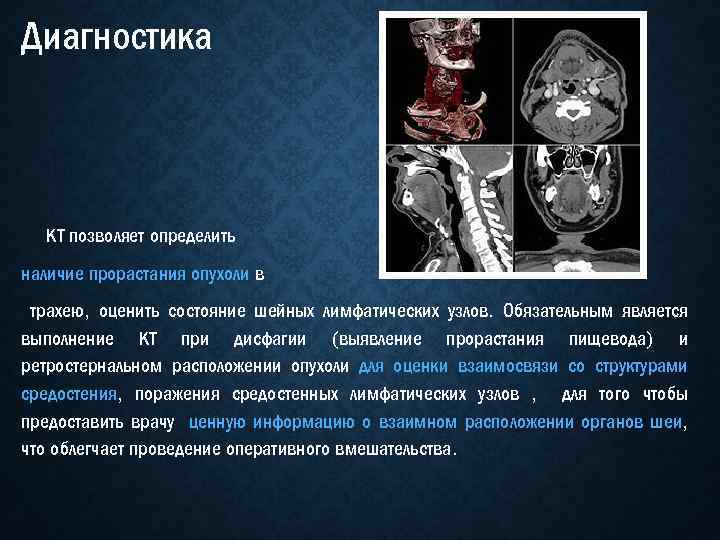 Диагностика КТ позволяет определить наличие прорастания опухоли в трахею, оценить состояние шейных лимфатических узлов.