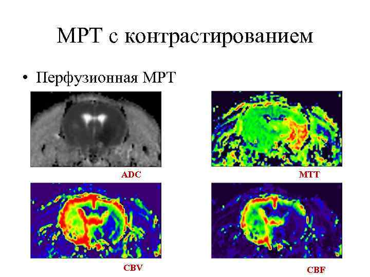 МРТ с контрастированием • Перфузионная МРТ ADC CBV MTT CBF 