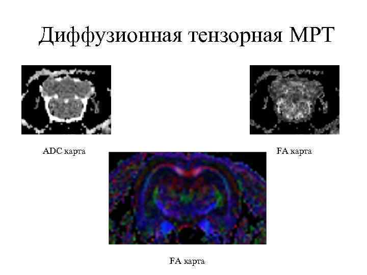 Диффузионная тензорная МРТ ADC карта FA карта 