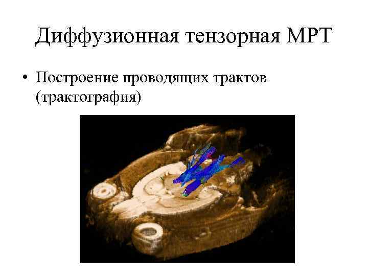 Мрт диффузное тензорное изображение