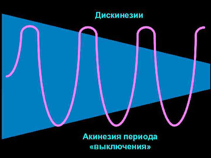 Дискинезии Акинезия периода «выключения» 