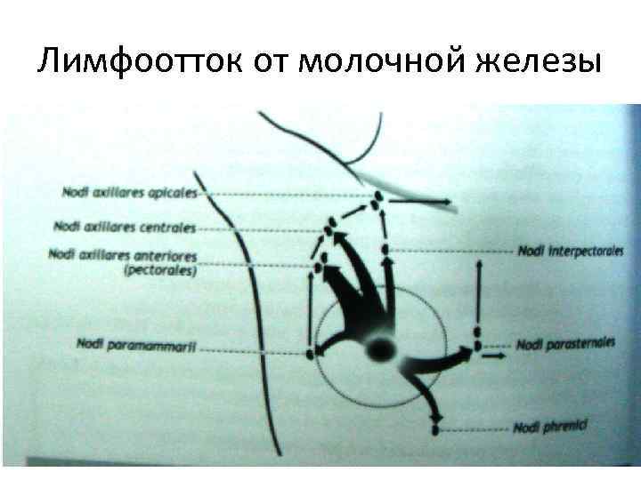 Лимфоотток от молочной железы 