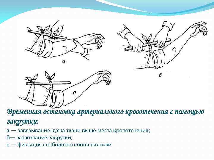 План наложения жгута