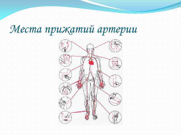 Места прижатий артерии 