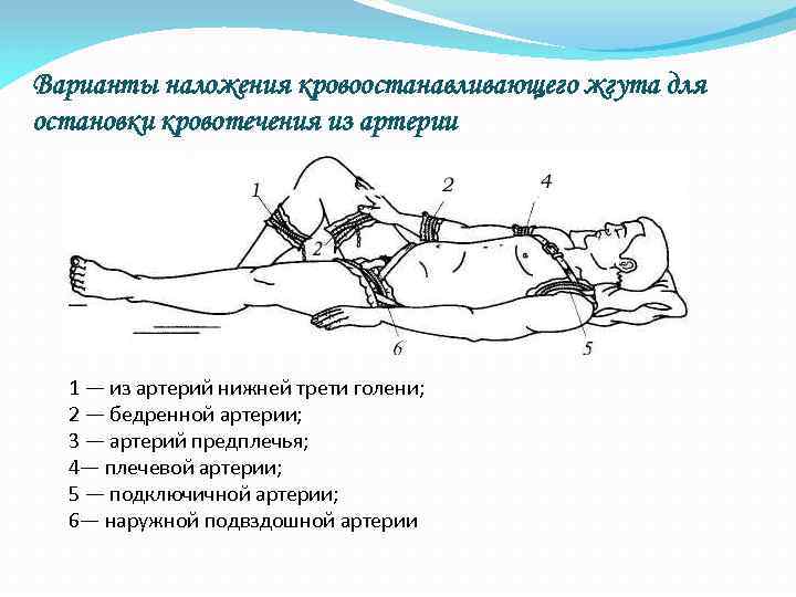 При кровотечении из артерии накладывается. Метод наложения кровоостанавливающего жгута. Типичные места наложения жгута при артериальном кровотечении. Остановка кровотечения из подвздошной артерии. Остановка кровотечения бедренной артерии жгутом.