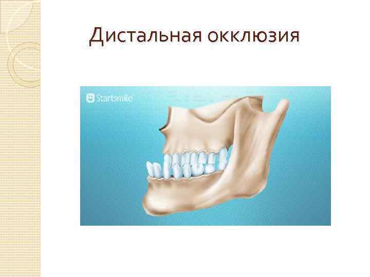 Дистальная окклюзия