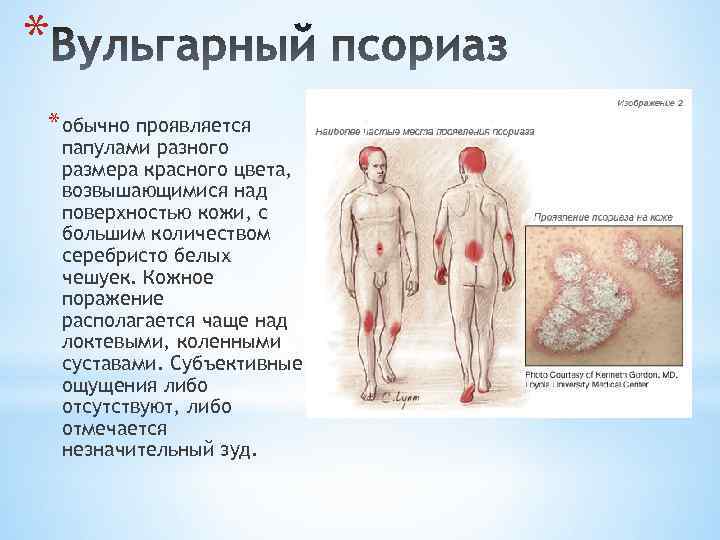 * * обычно проявляется папулами разного размера красного цвета, возвышающимися над поверхностью кожи, с