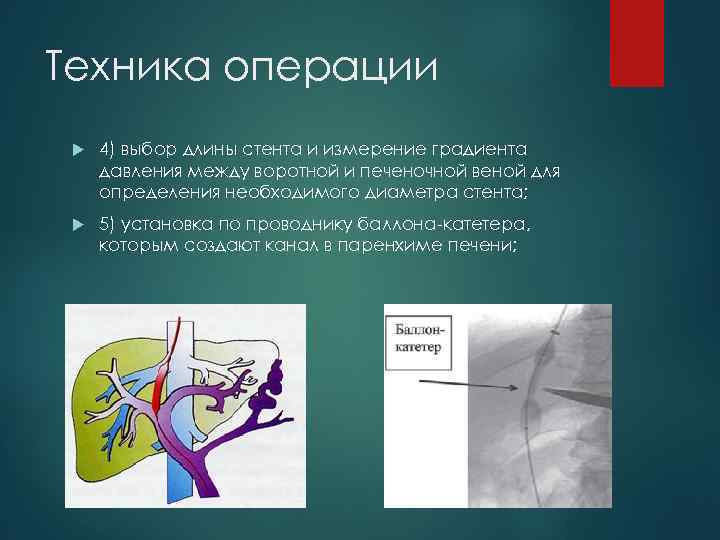 Техника операции 4) выбор длины стента и измерение градиента давления между воротной и печеночной