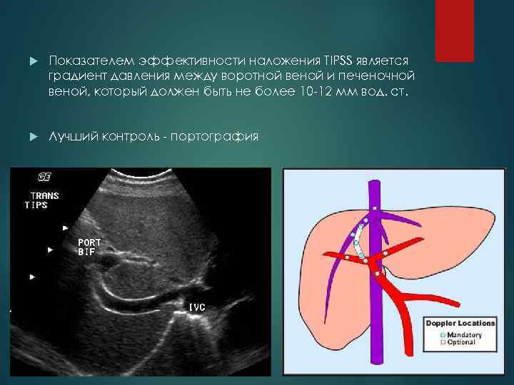  Показателем эффективности наложения TIPSS является градиент давления между воротной веной и печеночной веной,