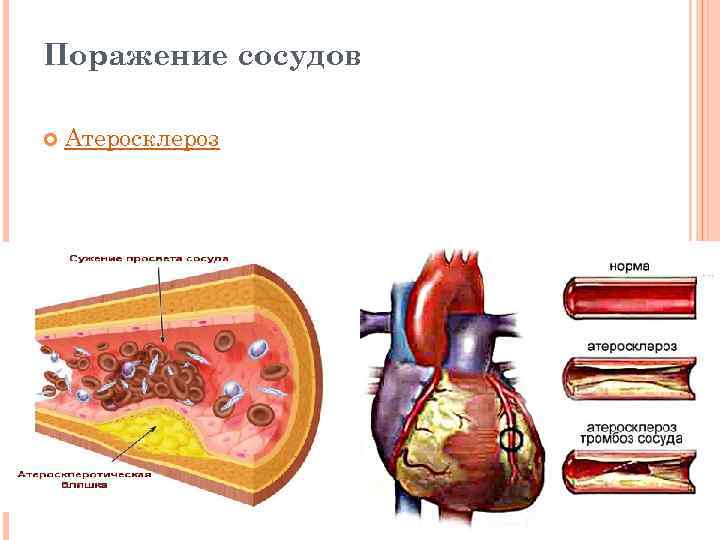 Поражение сосудов Атеросклероз 