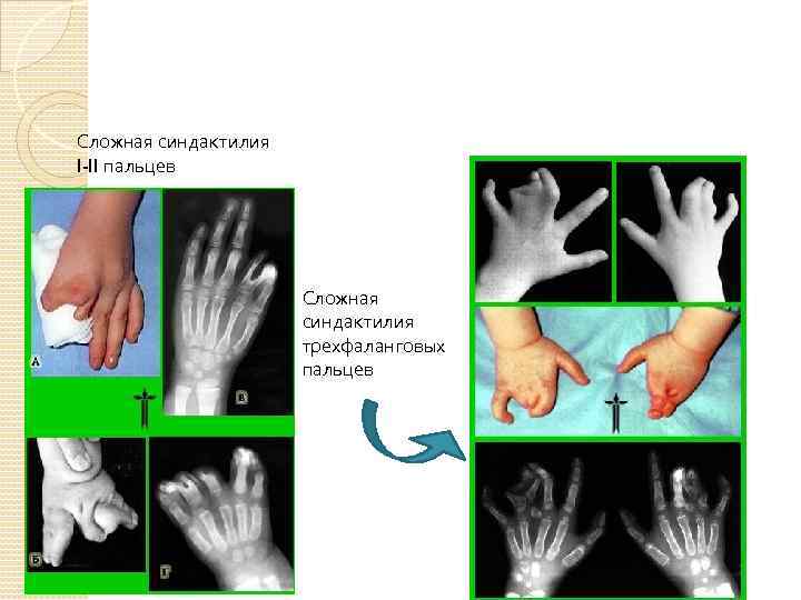 Сложная синдактилия I-II пальцев Сложная синдактилия трехфаланговых пальцев 