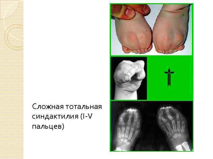 Сложная тотальная синдактилия (I-V пальцев) 