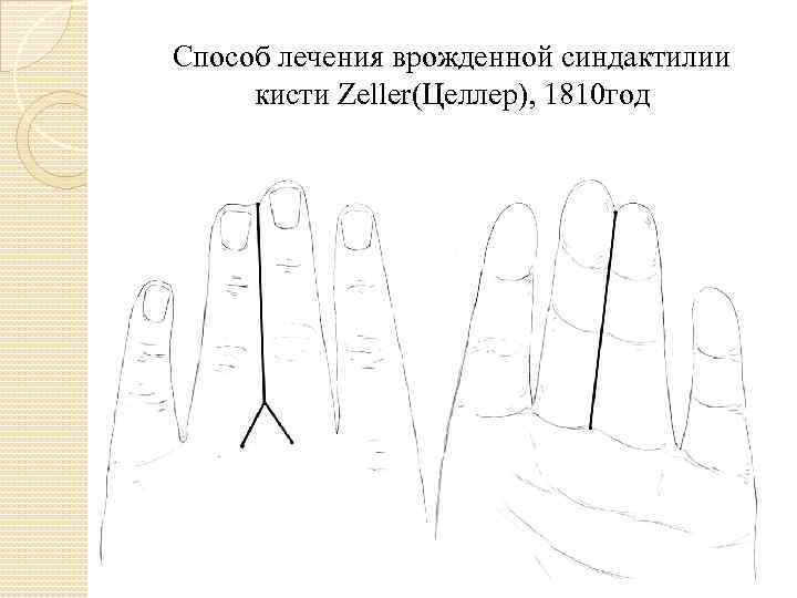 Способ лечения врожденной синдактилии кисти Zeller(Целлер), 1810 год 