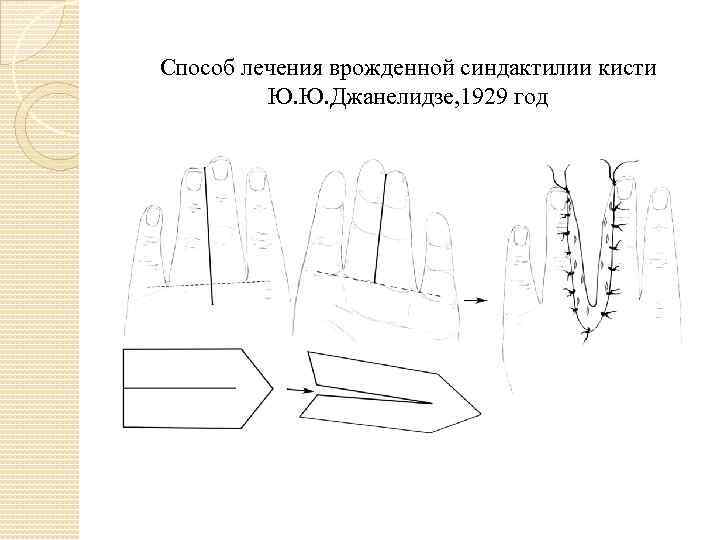 Способ лечения врожденной синдактилии кисти Ю. Ю. Джанелидзе, 1929 год 