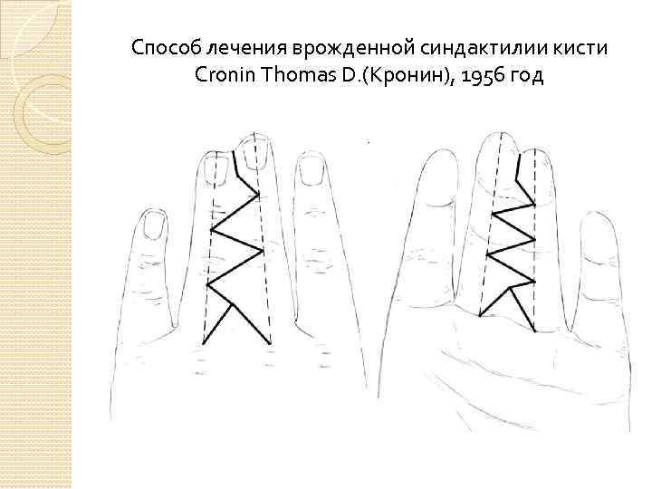 Способ лечения врожденной синдактилии кисти Cronin Thomas D. (Кронин), 1956 год 