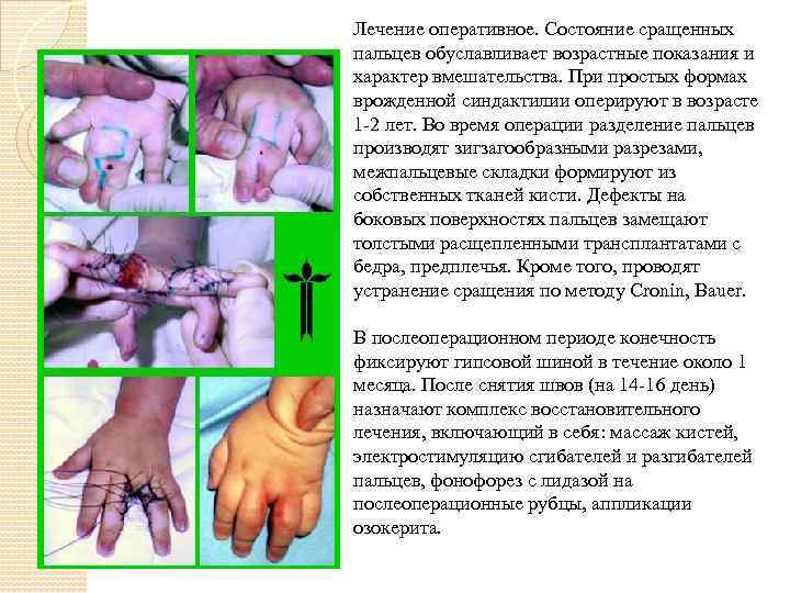 Лечение оперативное. Состояние сращенных пальцев обуславливает возрастные показания и характер вмешательства. При простых формах