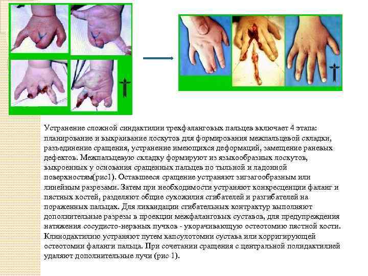 Устранение сложной синдактилии трехфаланговых пальцев включает 4 этапа: планирование и выкраивание лоскутов для формирования