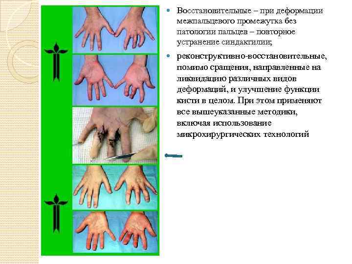  Восстановительные – при деформации межпальцевого промежутка без патологии пальцев – повторное устранение синдактилии;