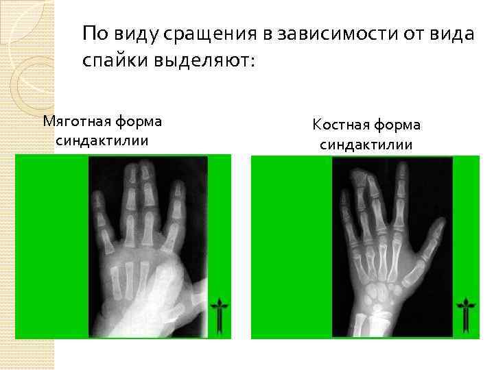 По виду сращения в зависимости от вида спайки выделяют: Мяготная форма синдактилии Костная форма