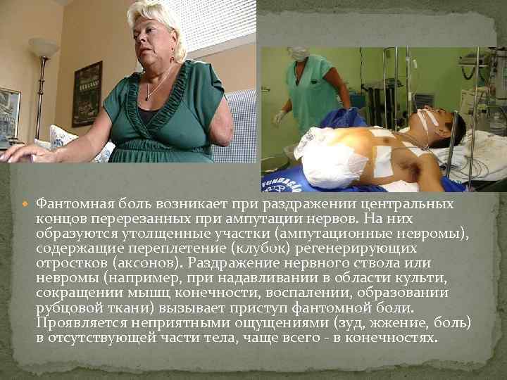  Фантомная боль возникает при раздражении центральных концов перерезанных при ампутации нервов. На них