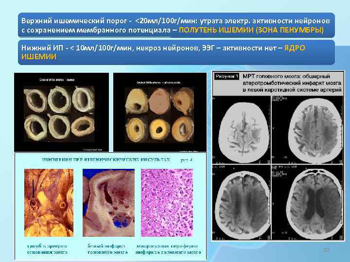 Верхний ишемический порог - <20 мл/100 г/мин: утрата электр. активности нейронов с сохранением мембранного