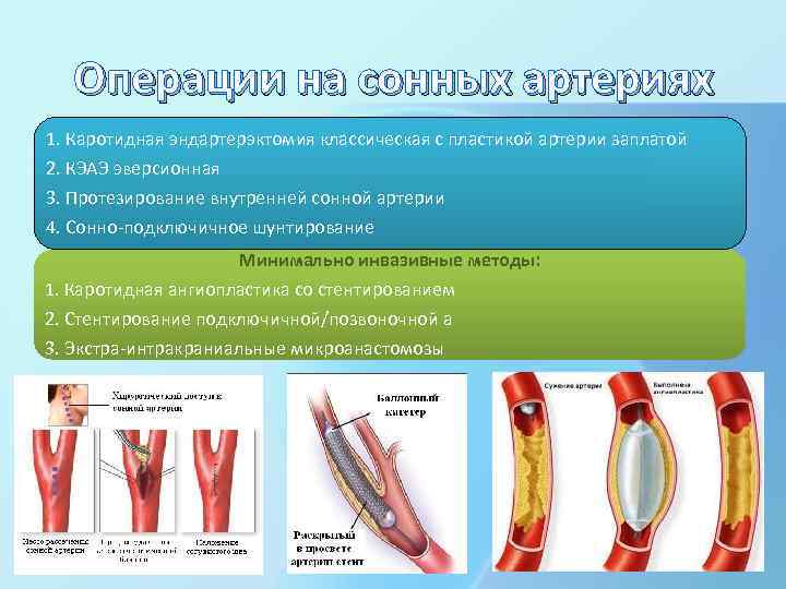 Операции на сонных артериях 1. Каротидная эндартерэктомия классическая с пластикой артерии заплатой 2. КЭАЭ