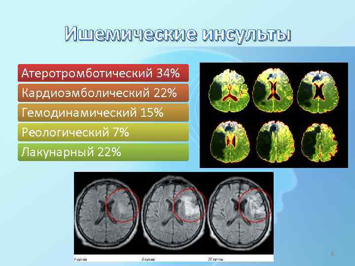 Ишемические инсульты Атеротромботический 34% Кардиоэмболический 22% Гемодинамический 15% Реологический 7% Лакунарный 22% 8 