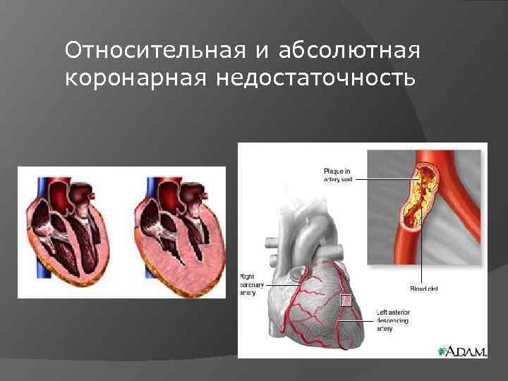 Относительная и абсолютная коронарная недостаточность 