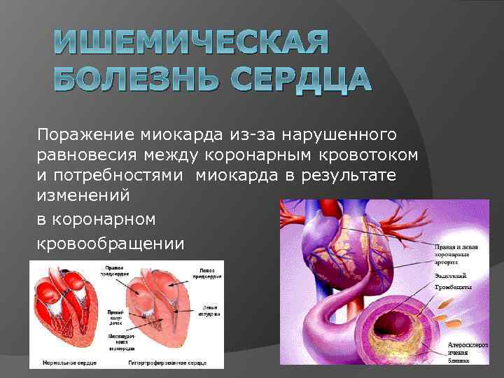 ИШЕМИЧЕСКАЯ БОЛЕЗНЬ СЕРДЦА Поражение миокарда из за нарушенного равновесия между коронарным кровотоком и потребностями