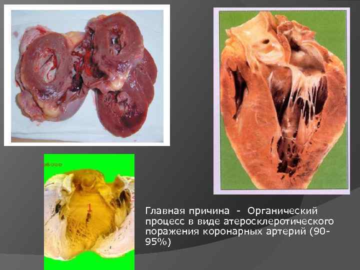 Главная причина Органический процесс в виде атеросклеротического поражения коронарных артерий (90 95%) 
